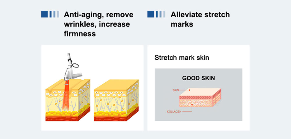 CO2 fractional laser reconstruction and treatment of the skin