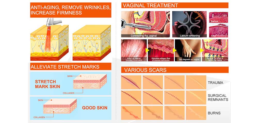 German 808 advanced hair removal equipment