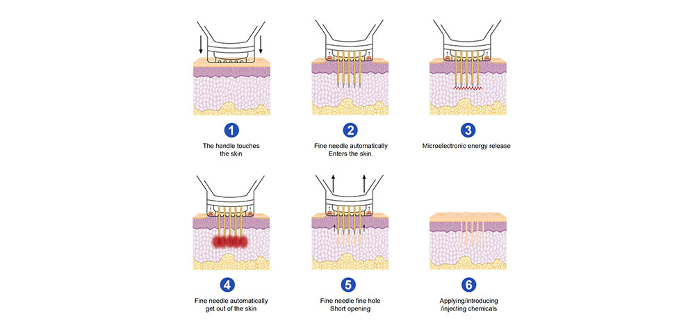 The Working Principle of Golden RF Micro needle