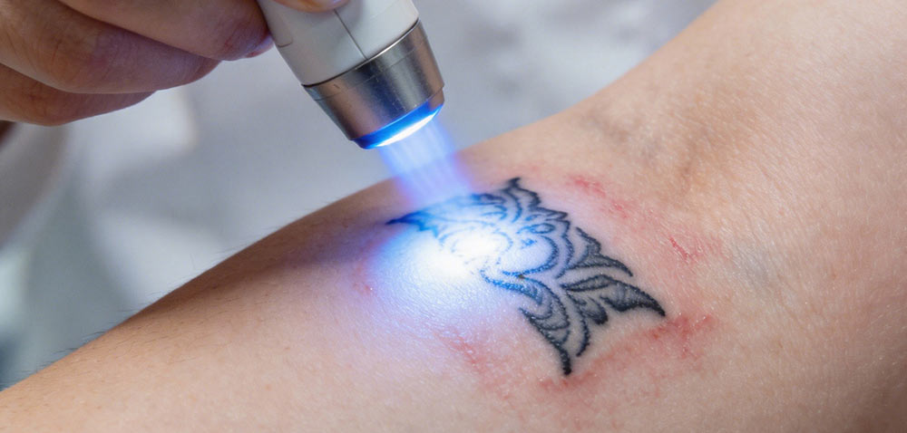 Laser Tattoo Removal Machine Manufacturer for Professional Clinics in Europe and the US