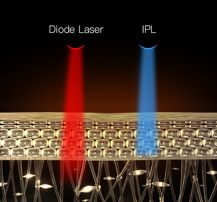 Diode Laser Differ from IPL
