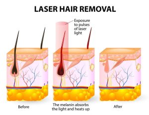 Laser Hair Removal Treatment ResultsLaser Hair Removal Treatment Results