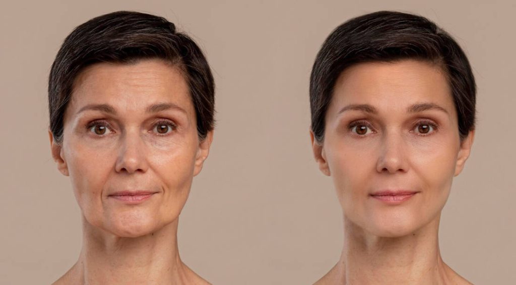 What Do Microneedling Before and After Results Really Look Like